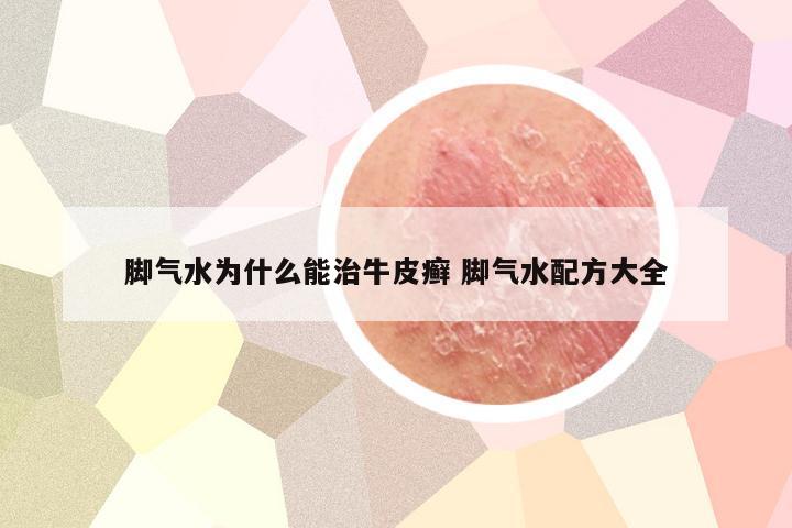 脚气水为什么能治牛皮癣 脚气水配方大全