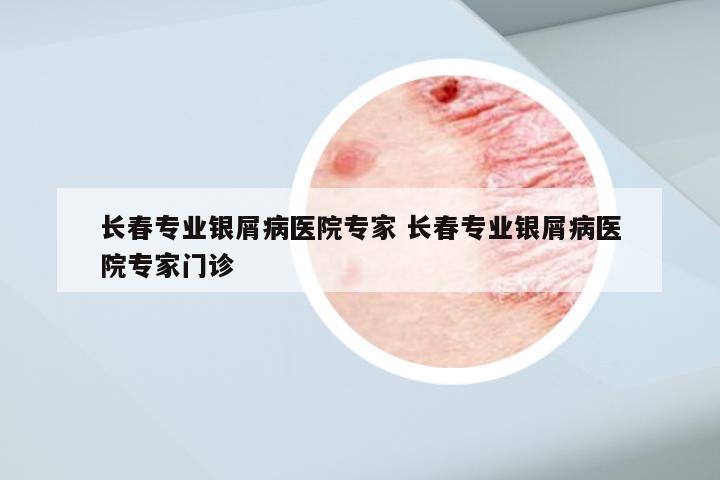 长春专业银屑病医院专家 长春专业银屑病医院专家门诊