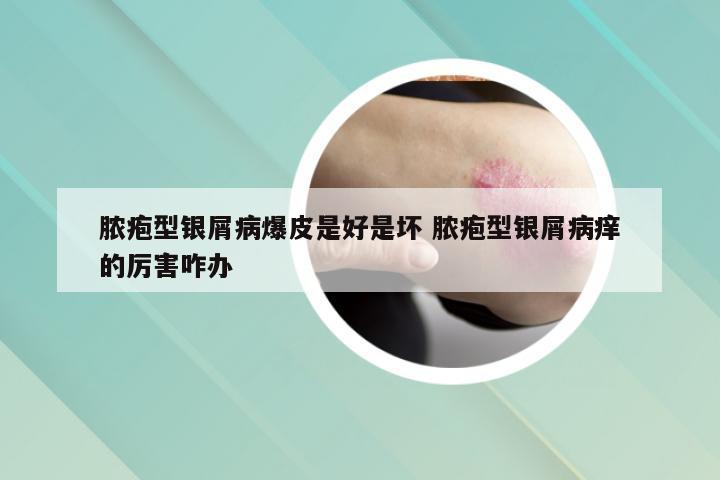 脓疱型银屑病爆皮是好是坏 脓疱型银屑病痒的厉害咋办