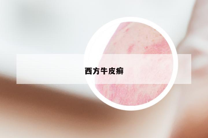 西方牛皮癣