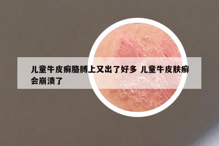 儿童牛皮癣胳膊上又出了好多 儿童牛皮肤癣会崩溃了