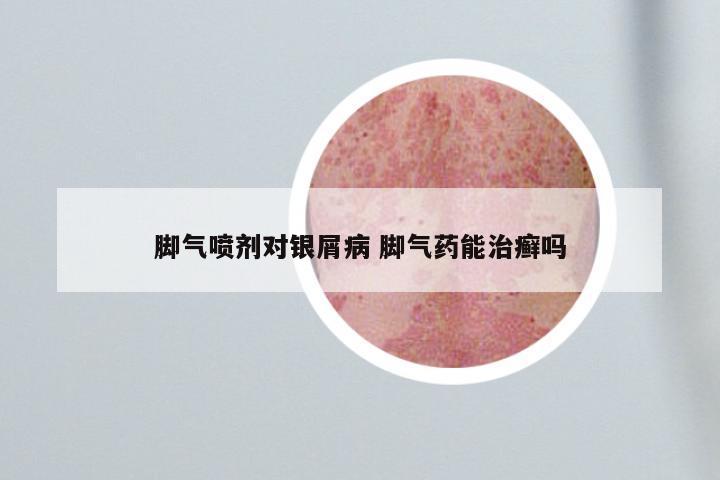脚气喷剂对银屑病 脚气药能治癣吗