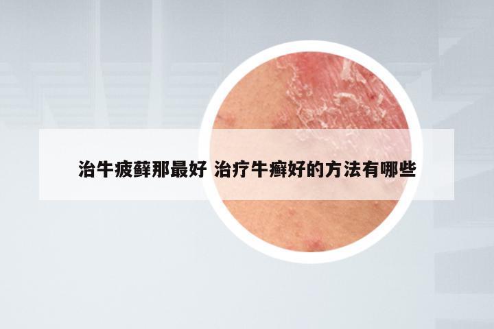 治牛疲藓那最好 治疗牛癣好的方法有哪些
