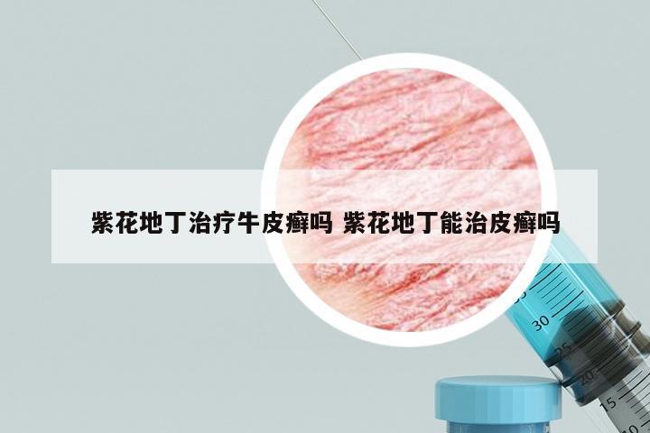 紫花地丁治疗牛皮癣吗 紫花地丁能治皮癣吗