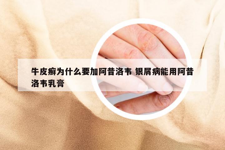 牛皮癣为什么要加阿昔洛韦 银屑病能用阿昔洛韦乳膏