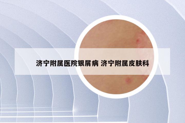 济宁附属医院银屑病 济宁附属皮肤科