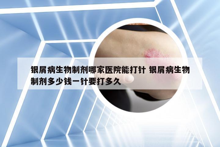 银屑病生物制剂哪家医院能打针 银屑病生物制剂多少钱一针要打多久