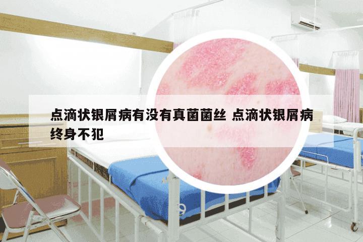 点滴状银屑病有没有真菌菌丝 点滴状银屑病终身不犯