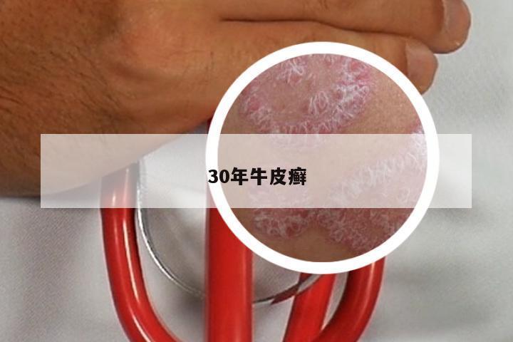 30年牛皮癣