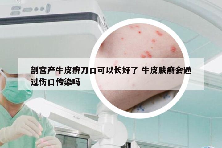 剖宫产牛皮癣刀口可以长好了 牛皮肤癣会通过伤口传染吗