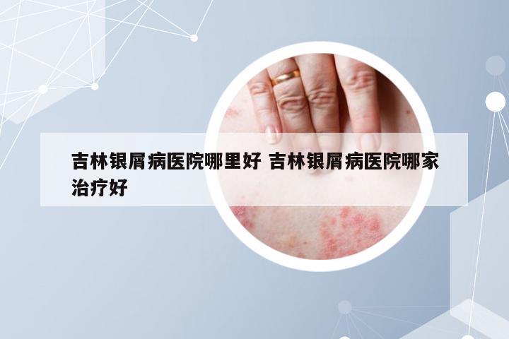 吉林银屑病医院哪里好 吉林银屑病医院哪家治疗好
