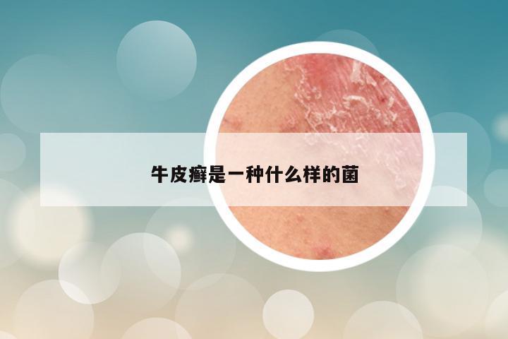 牛皮癣是一种什么样的菌