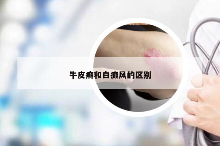 牛皮癣和白癫风的区别
