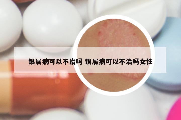 银屑病可以不治吗 银屑病可以不治吗女性