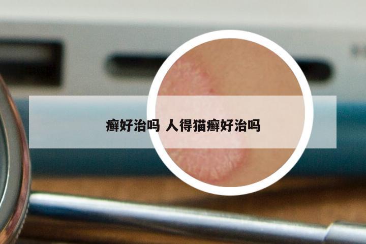 癣好治吗 人得猫癣好治吗