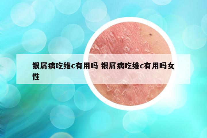 银屑病吃维c有用吗 银屑病吃维c有用吗女性