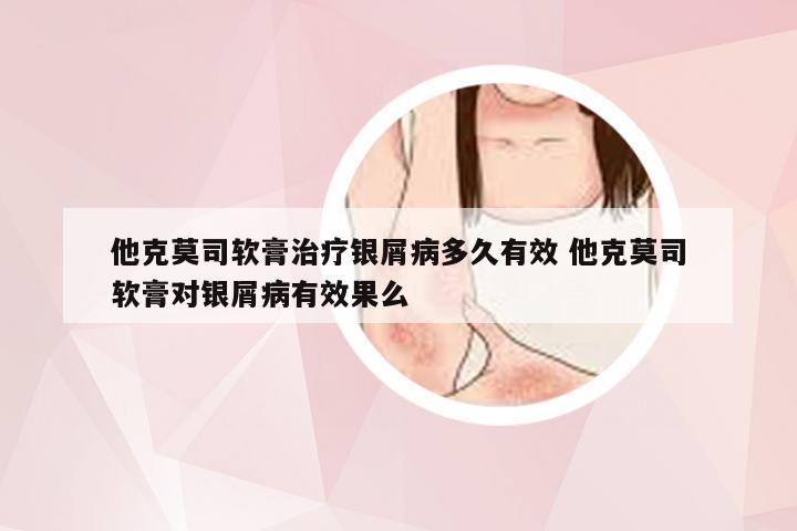他克莫司软膏治疗银屑病多久有效 他克莫司软膏对银屑病有效果么