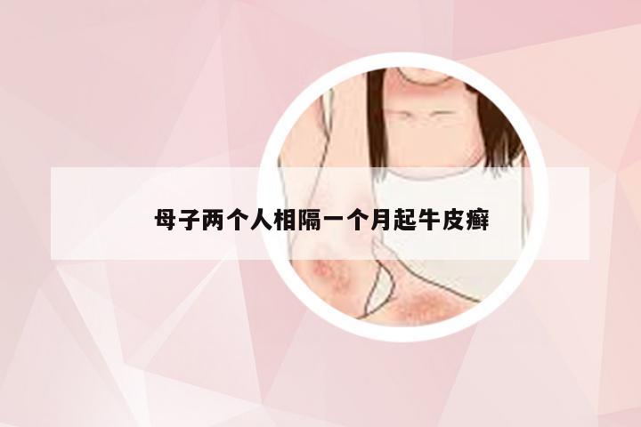 母子两个人相隔一个月起牛皮癣