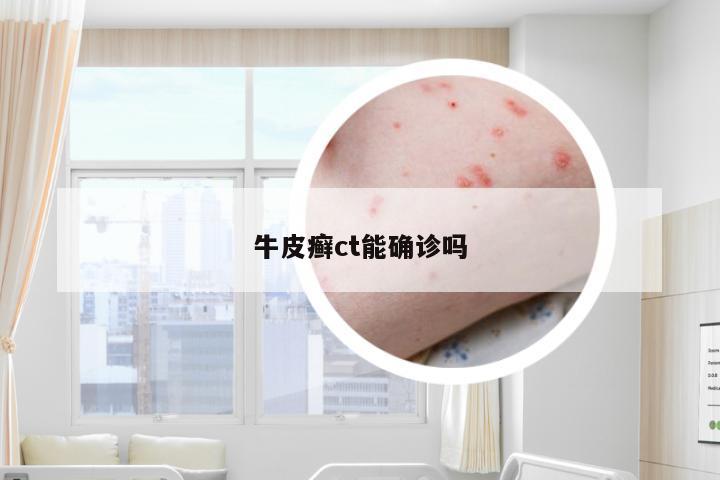 牛皮癣ct能确诊吗