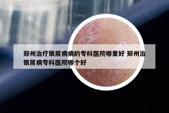 郑州治疗银屑病病的专科医院哪里好 郑州治银屑病专科医院哪个好