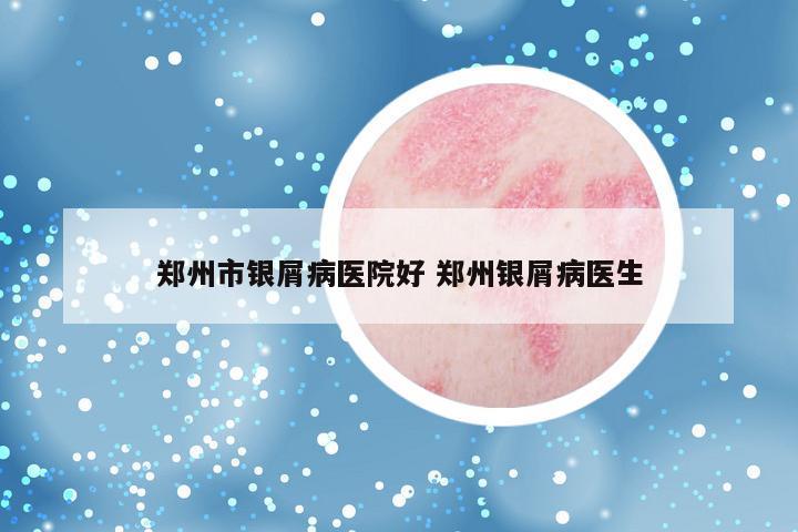 郑州市银屑病医院好 郑州银屑病医生
