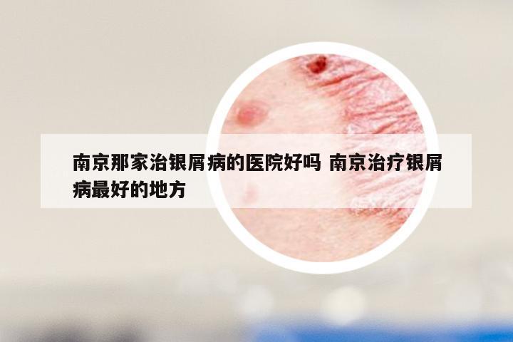南京那家治银屑病的医院好吗 南京治疗银屑病最好的地方