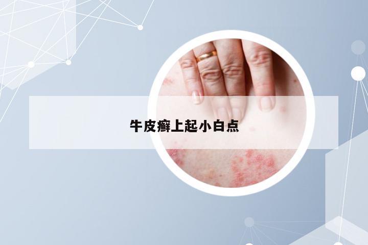 牛皮癣上起小白点
