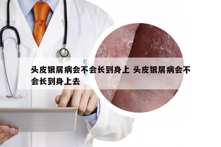 头皮银屑病会不会长到身上 头皮银屑病会不会长到身上去