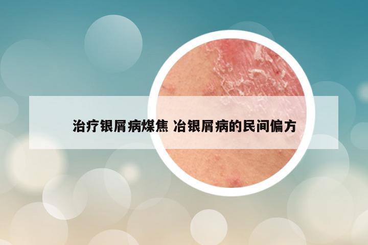 治疗银屑病煤焦 冶银屑病的民间偏方