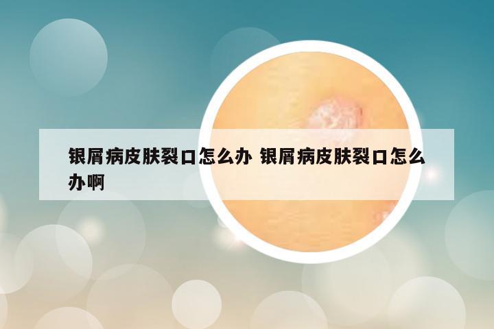 银屑病皮肤裂口怎么办 银屑病皮肤裂口怎么办啊
