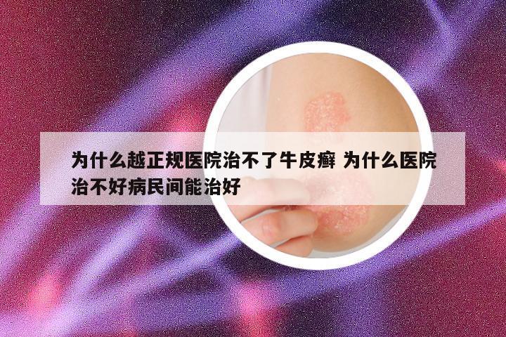 为什么越正规医院治不了牛皮癣 为什么医院治不好病民间能治好
