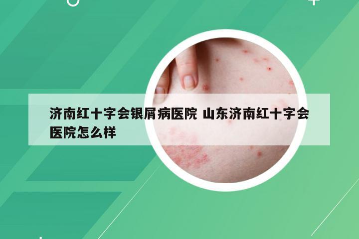 济南红十字会银屑病医院 山东济南红十字会医院怎么样
