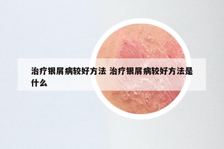 治疗银屑病较好方法 治疗银屑病较好方法是什么