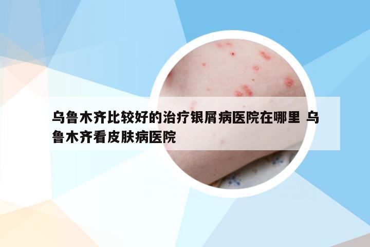 乌鲁木齐比较好的治疗银屑病医院在哪里 乌鲁木齐看皮肤病医院