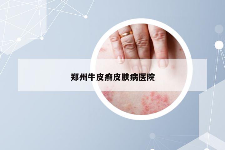 郑州牛皮癣皮肤病医院