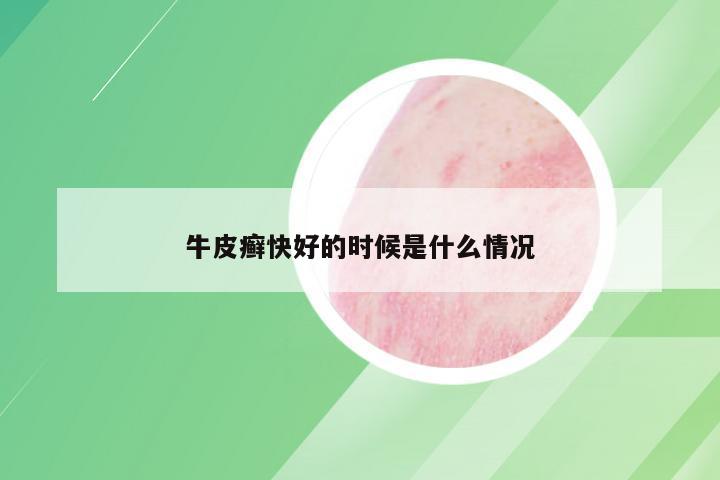 牛皮癣快好的时候是什么情况