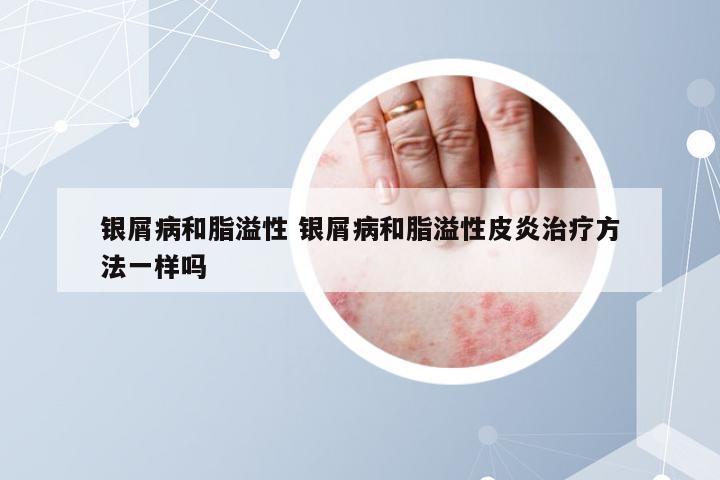 银屑病和脂溢性 银屑病和脂溢性皮炎治疗方法一样吗