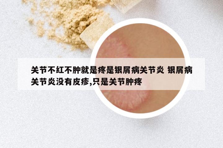 关节不红不肿就是疼是银屑病关节炎 银屑病关节炎没有皮疹,只是关节肿疼