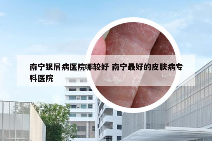 南宁银屑病医院哪较好 南宁最好的皮肤病专科医院