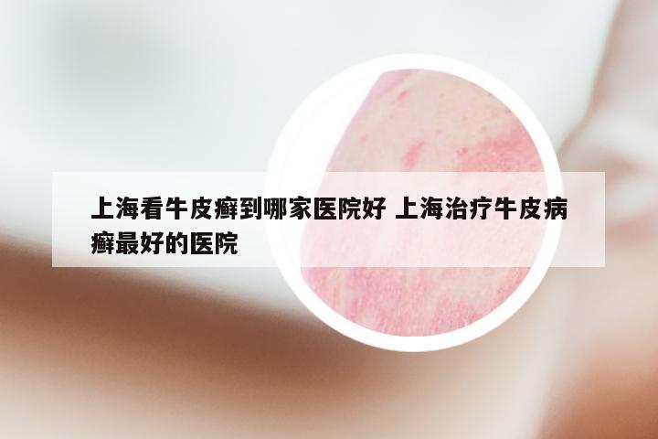 上海看牛皮癣到哪家医院好 上海治疗牛皮病癣最好的医院