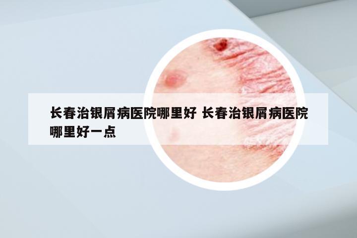 长春治银屑病医院哪里好 长春治银屑病医院哪里好一点