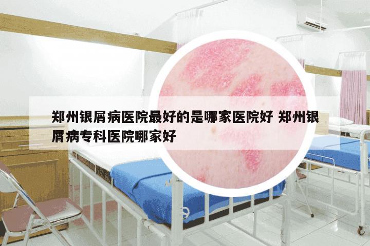 郑州银屑病医院最好的是哪家医院好 郑州银屑病专科医院哪家好