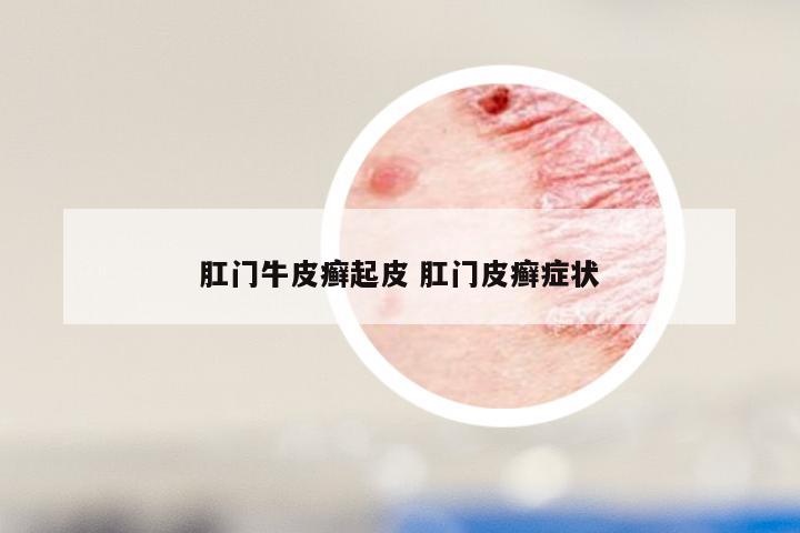 肛门牛皮癣起皮 肛门皮癣症状