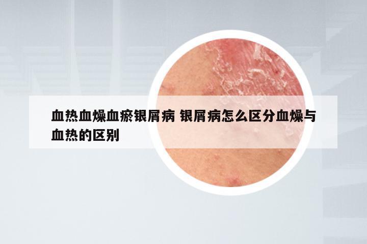 血热血燥血瘀银屑病 银屑病怎么区分血燥与血热的区别