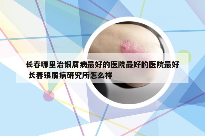 长春哪里治银屑病最好的医院最好的医院最好 长春银屑病研究所怎么样