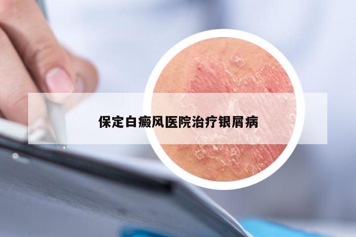 保定白癜风医院治疗银屑病
