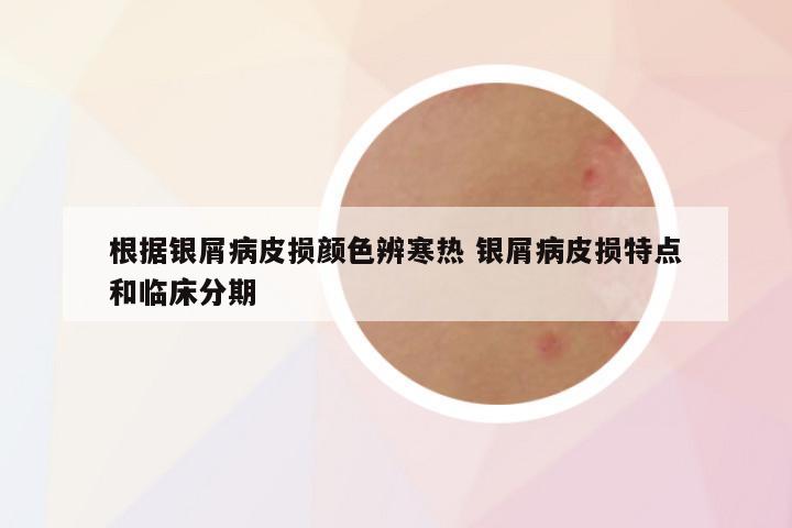 根据银屑病皮损颜色辨寒热 银屑病皮损特点和临床分期