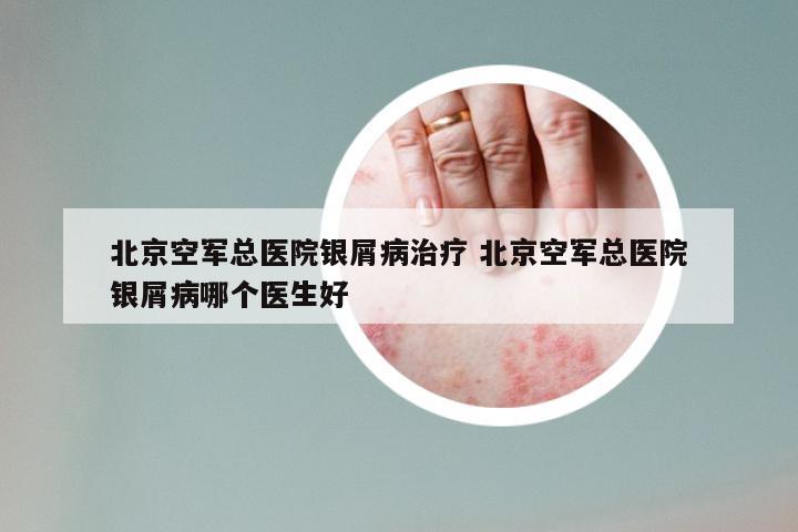 北京空军总医院银屑病治疗 北京空军总医院银屑病哪个医生好