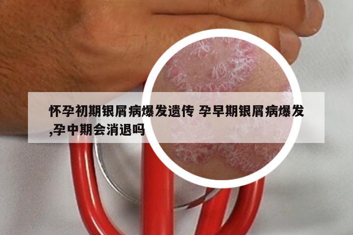 怀孕初期银屑病爆发遗传 孕早期银屑病爆发,孕中期会消退吗