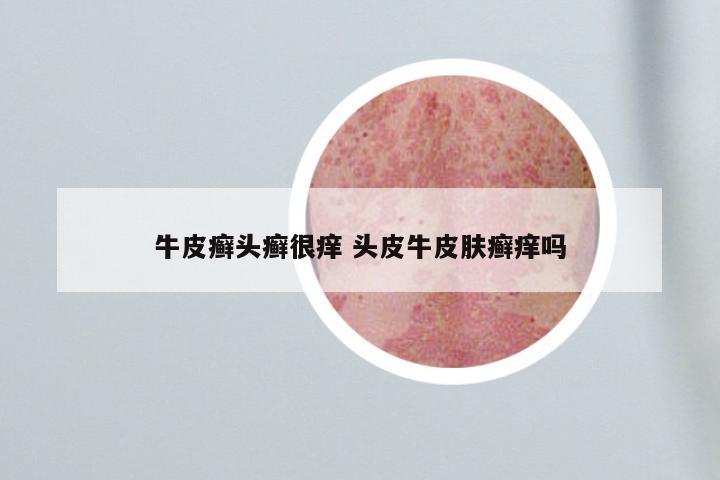 牛皮癣头癣很痒 头皮牛皮肤癣痒吗
